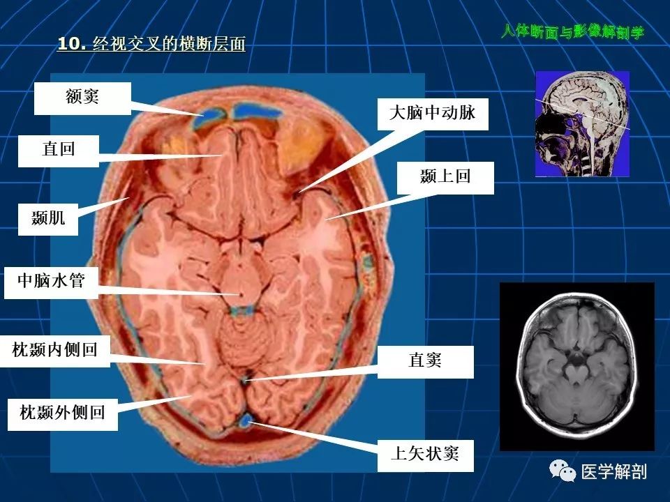 颅脑大体及磁共振断层解剖