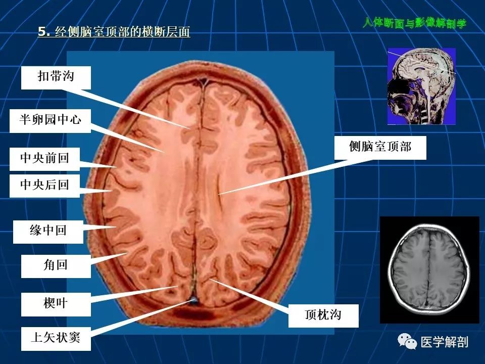 颅脑大体及磁共振断层解剖