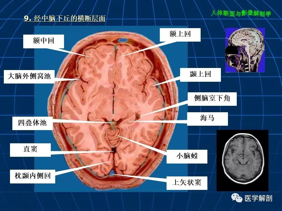 颅脑大体及磁共振断层解剖