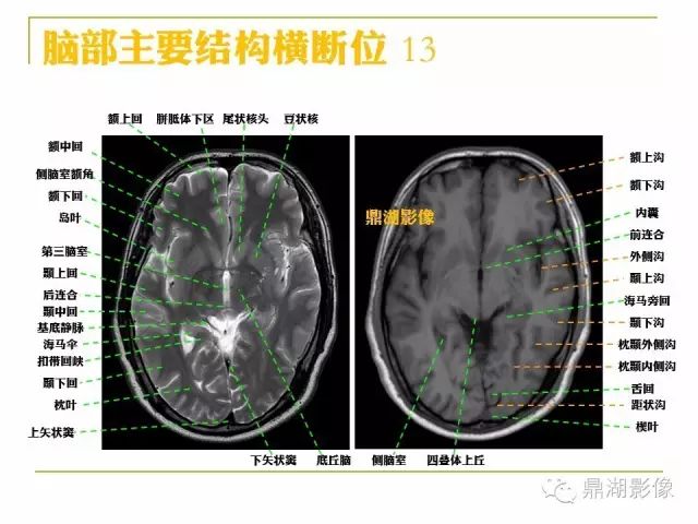 颅脑大体及磁共振断层解剖