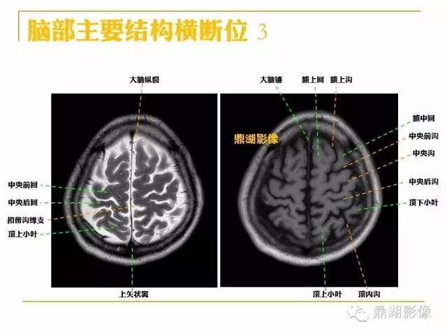 颅脑大体及磁共振断层解剖