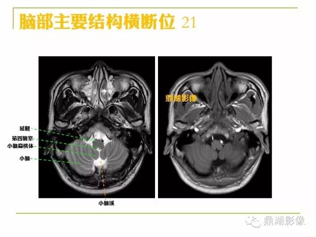 颅脑大体及磁共振断层解剖