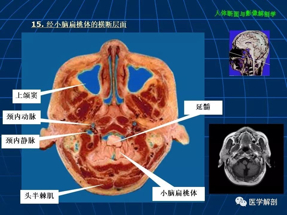 颅脑大体及磁共振断层解剖