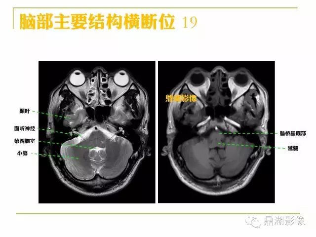 颅脑大体及磁共振断层解剖