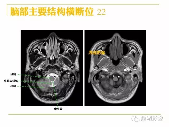 颅脑大体及磁共振断层解剖