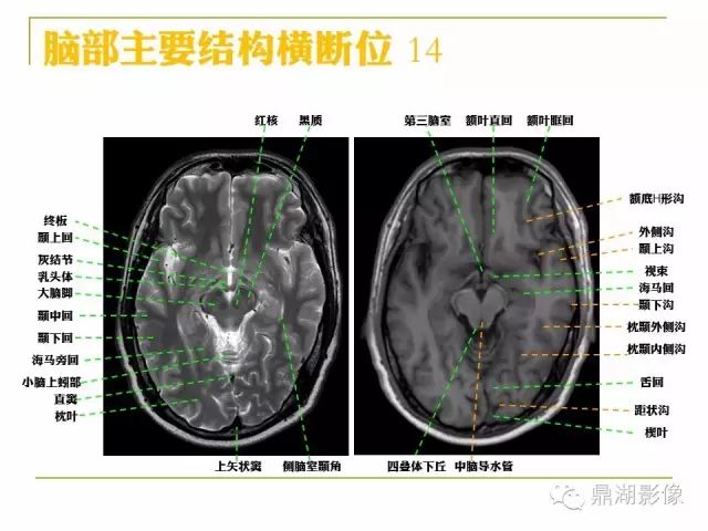 颅脑大体及磁共振断层解剖