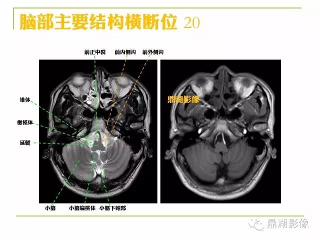 颅脑大体及磁共振断层解剖