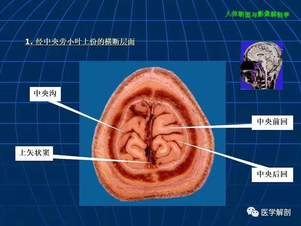 颅脑大体及磁共振断层解剖