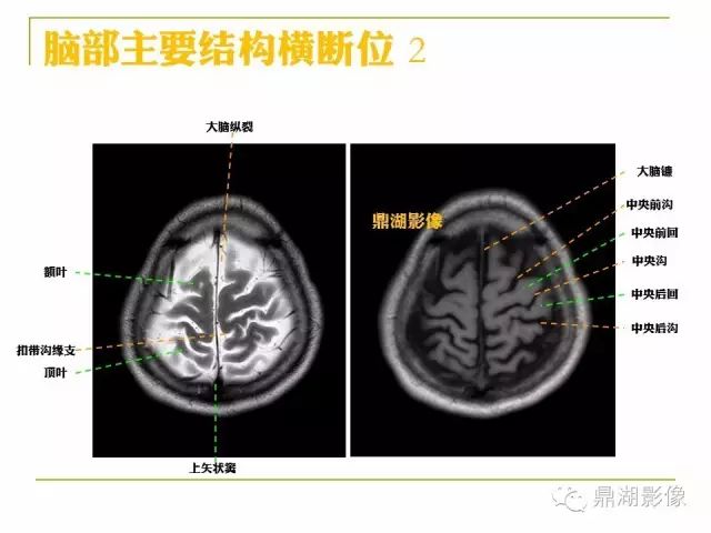 颅脑大体及磁共振断层解剖