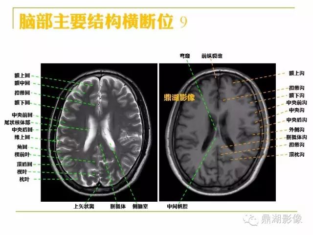 颅脑大体及磁共振断层解剖