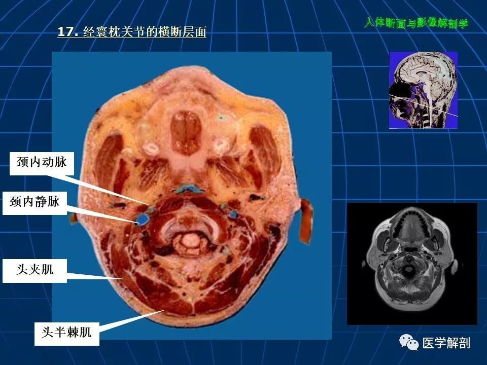 颅脑大体及磁共振断层解剖