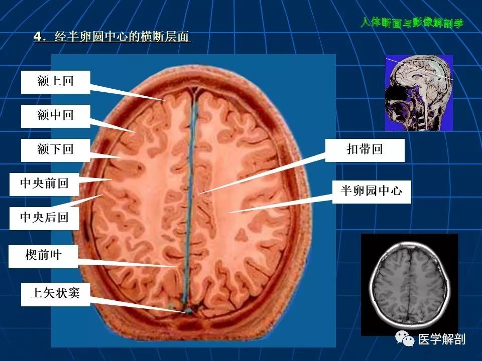 颅脑大体及磁共振断层解剖