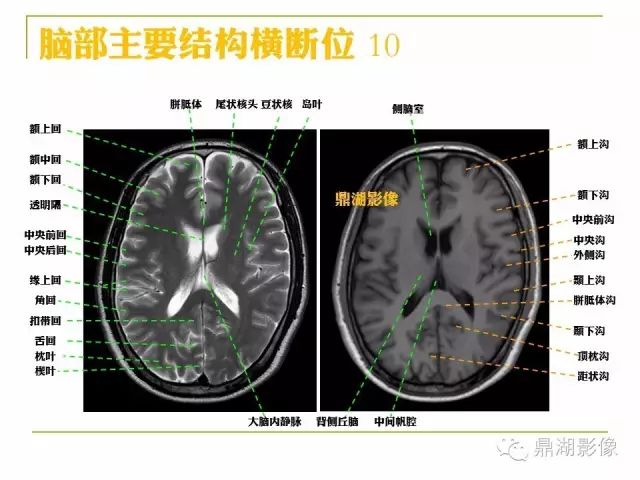 颅脑大体及磁共振断层解剖