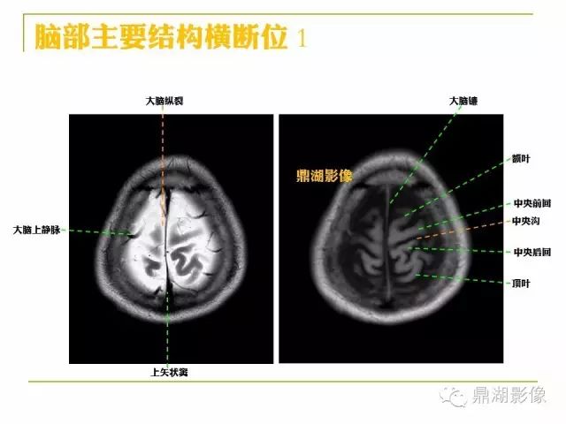 颅脑大体及磁共振断层解剖