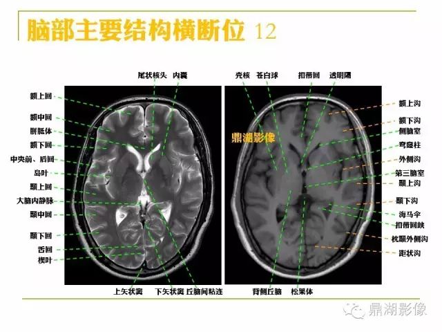 颅脑大体及磁共振断层解剖