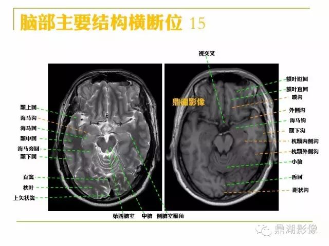 颅脑大体及磁共振断层解剖