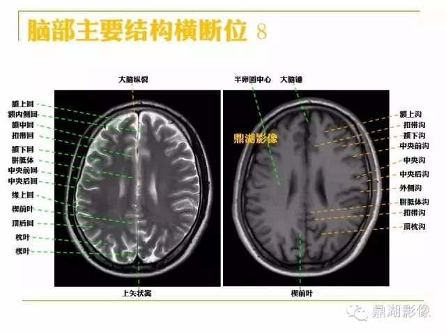 颅脑大体及磁共振断层解剖