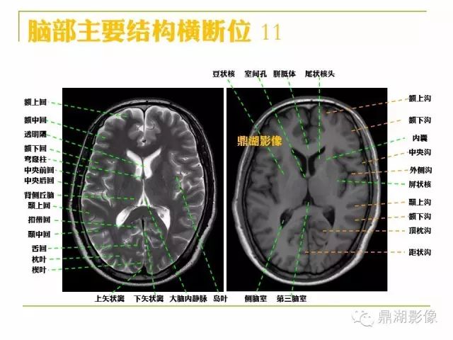 颅脑大体及磁共振断层解剖
