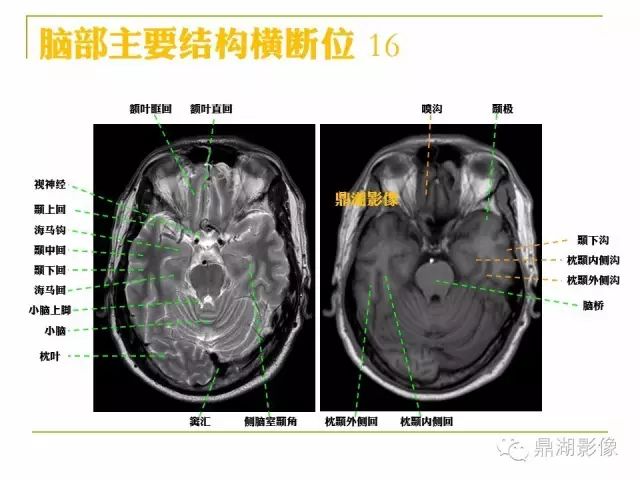颅脑大体及磁共振断层解剖