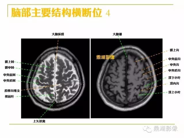 颅脑大体及磁共振断层解剖