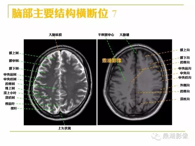 颅脑大体及磁共振断层解剖