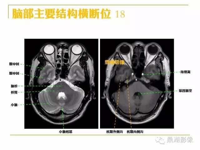 颅脑大体及磁共振断层解剖