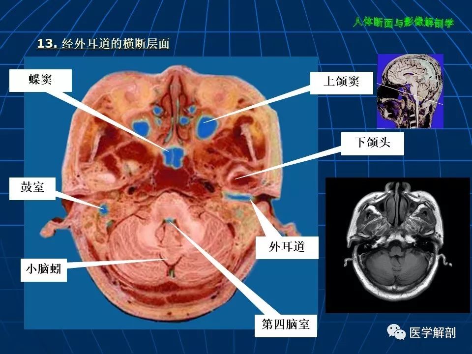 颅脑大体及磁共振断层解剖