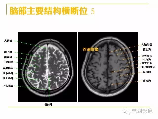 颅脑大体及磁共振断层解剖