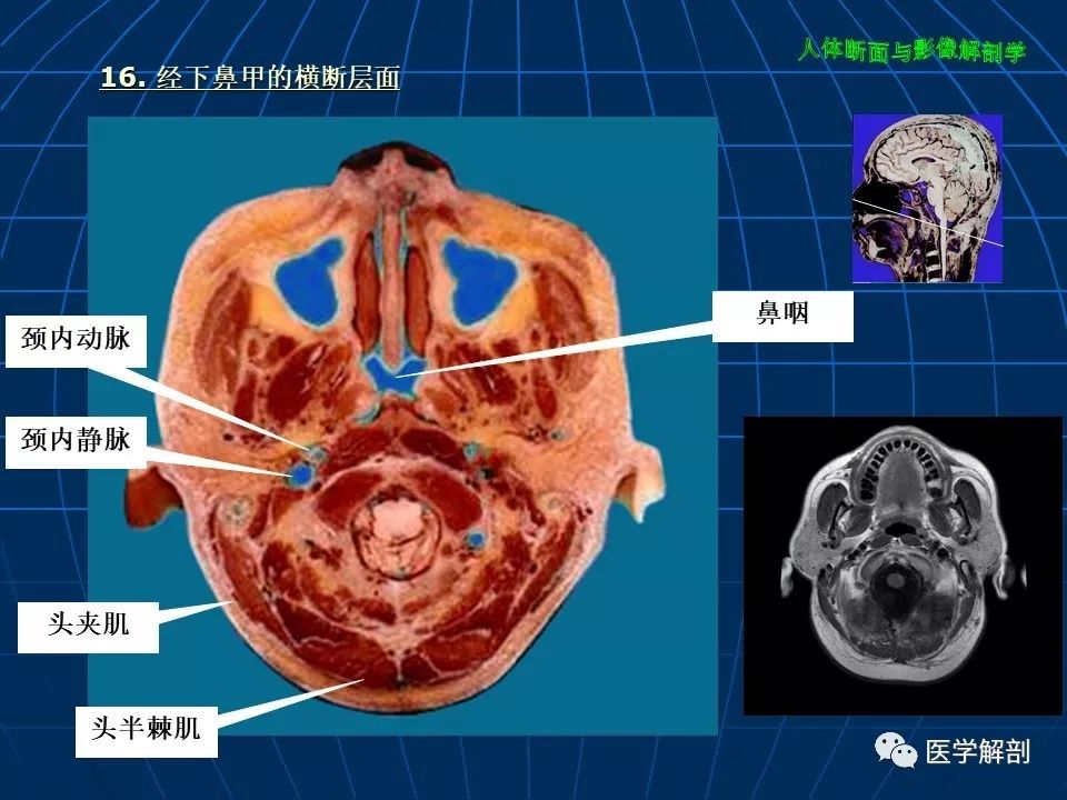 颅脑大体及磁共振断层解剖