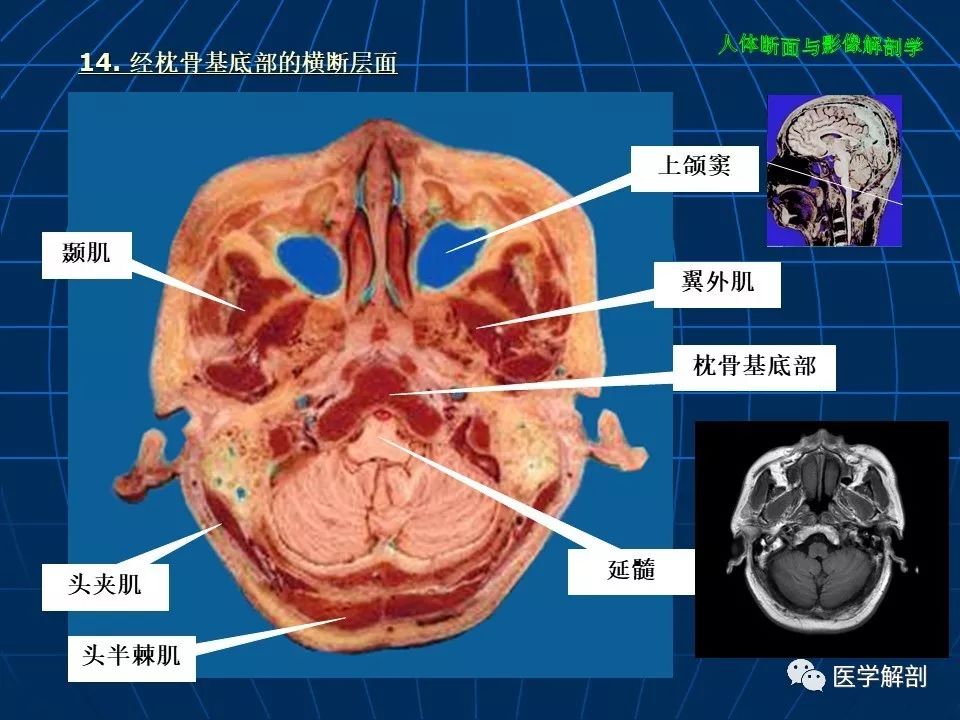 颅脑大体及磁共振断层解剖