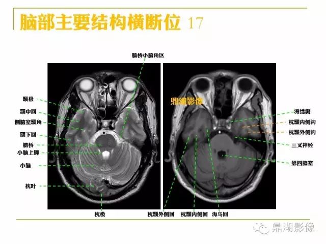颅脑大体及磁共振断层解剖