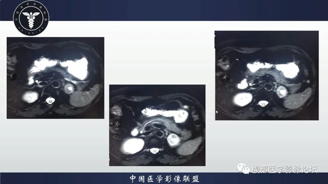 【病例】左肾癌(肾透明细胞癌)一例CT及MR影像