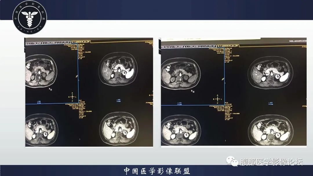 【病例】左肾癌(肾透明细胞癌)一例CT及MR影像