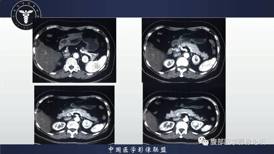 【病例】左肾癌(肾透明细胞癌)一例CT及MR影像
