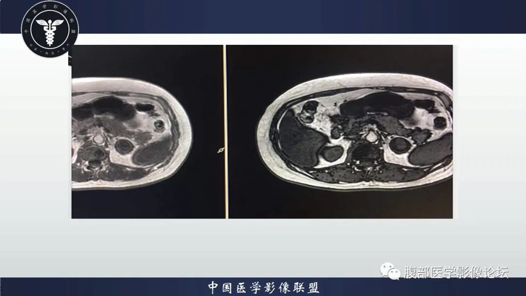【病例】左肾癌(肾透明细胞癌)一例CT及MR影像
