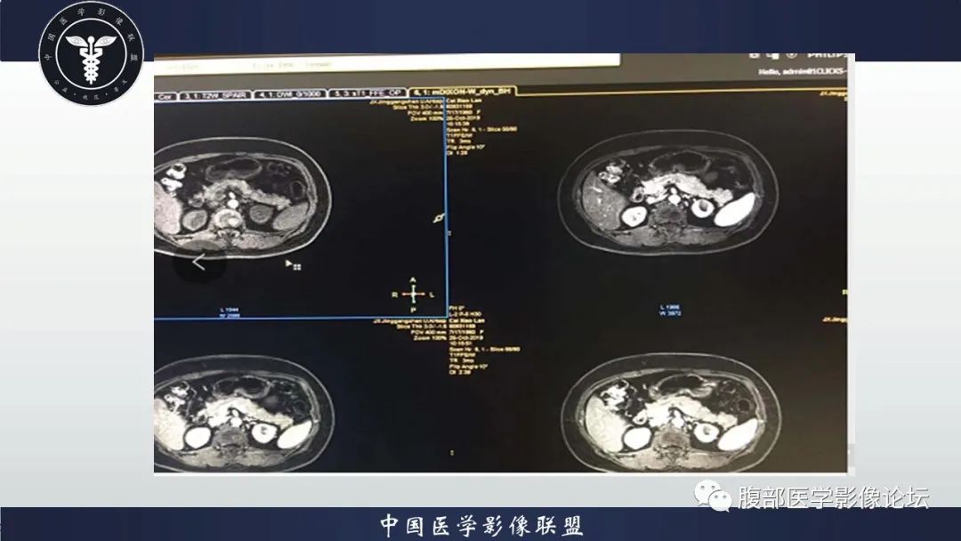 【病例】左肾癌(肾透明细胞癌)一例CT及MR影像