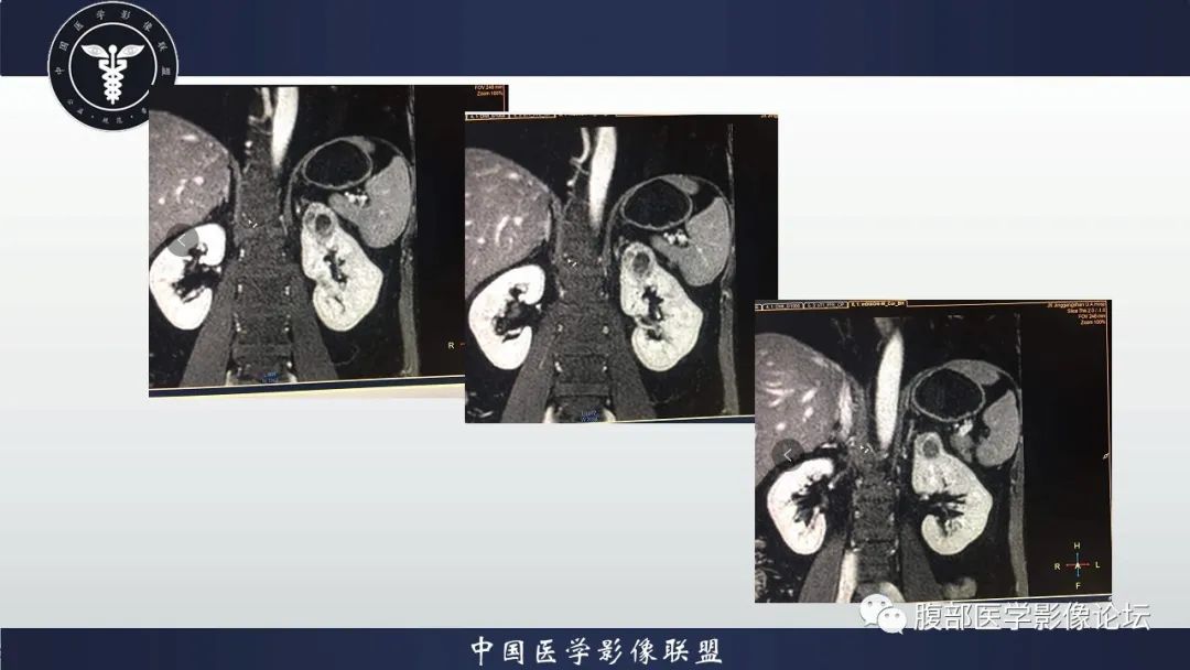 【病例】左肾癌(肾透明细胞癌)一例CT及MR影像