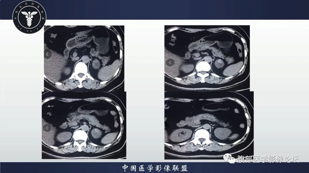 【病例】左肾癌(肾透明细胞癌)一例CT及MR影像