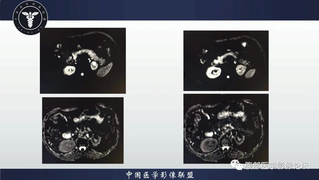 【病例】左肾癌(肾透明细胞癌)一例CT及MR影像