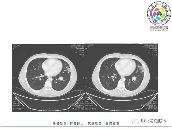【病例】 肺白塞氏病1例CT影像讨论