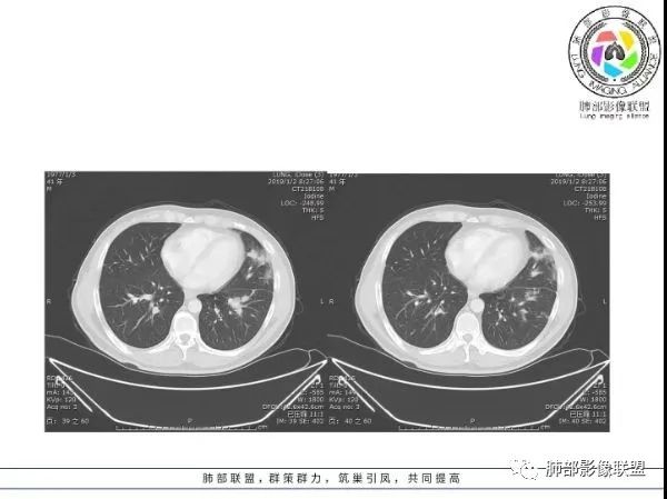 【病例】 肺白塞氏病1例CT影像讨论