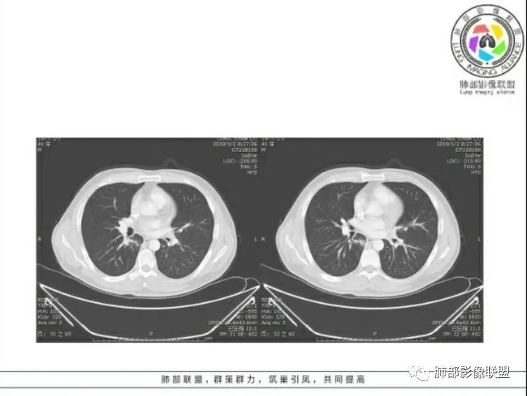 【病例】 肺白塞氏病1例CT影像讨论