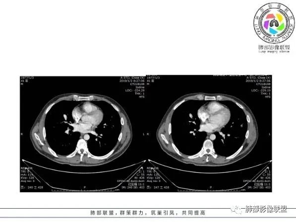 【病例】 肺白塞氏病1例CT影像讨论