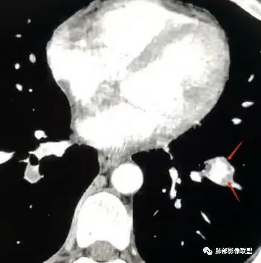 【病例】 肺白塞氏病1例CT影像讨论