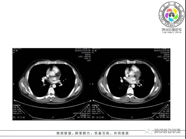 【病例】 肺白塞氏病1例CT影像讨论