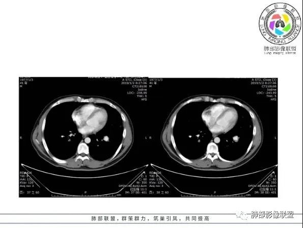 【病例】 肺白塞氏病1例CT影像讨论
