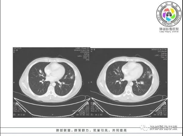 【病例】 肺白塞氏病1例CT影像讨论