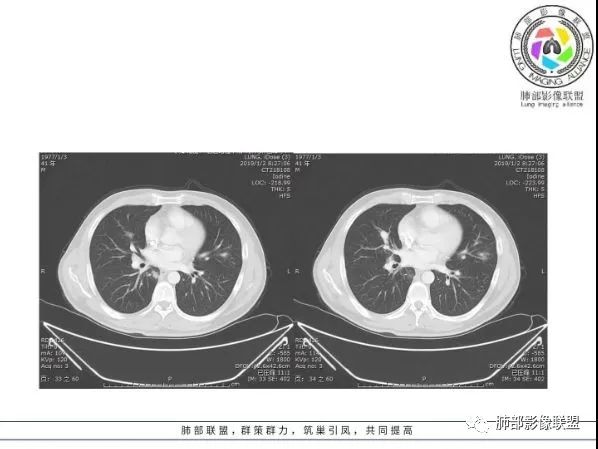 【病例】 肺白塞氏病1例CT影像讨论