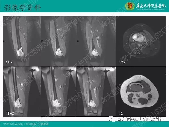 【病例】股骨尤文肉瘤1例CT及MR影像