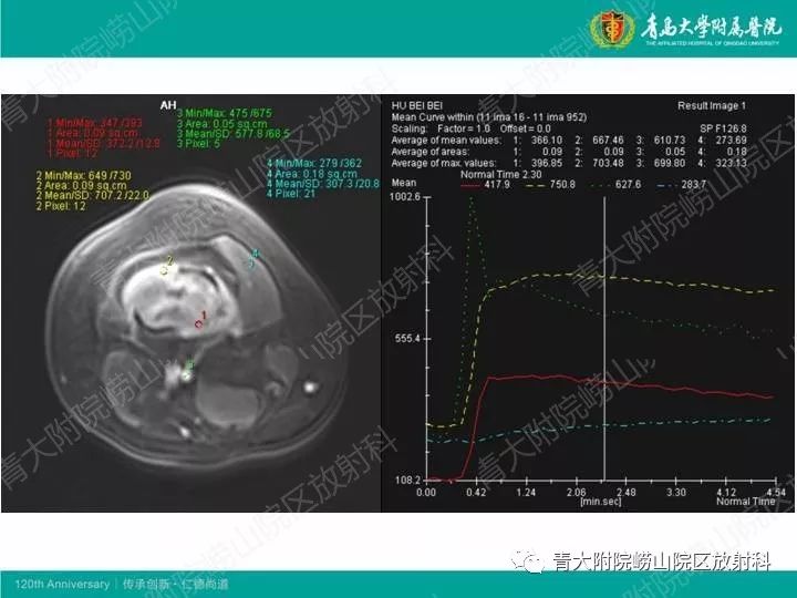 【病例】股骨尤文肉瘤1例CT及MR影像